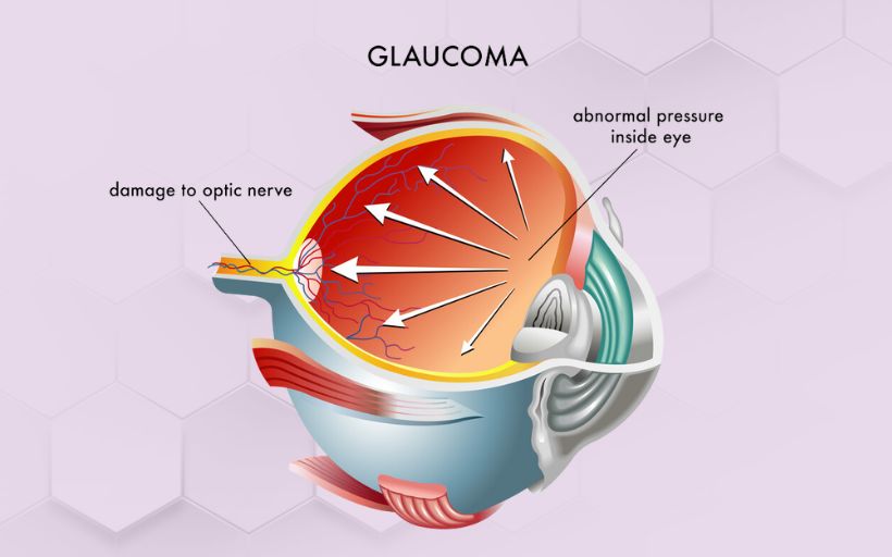 Top Reasons of Glaucoma And Understanding Risk Aspect