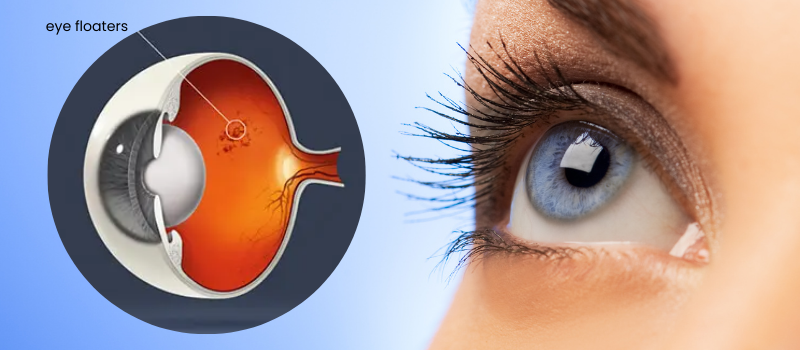 Eye Floaters Treatment