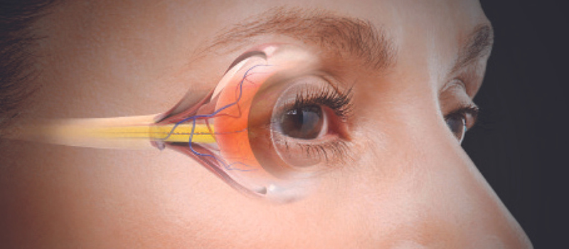 glaucoma treatment in chinchwad