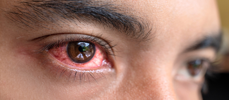 Red Eye Treatment
