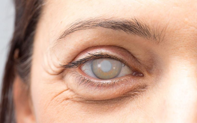 Cataracts Symptoms and Causes