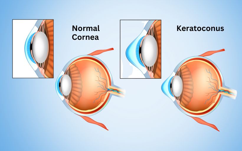 Signs of an Abnormal Cornea Symptoms Causes and Prevention